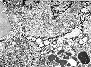 F, 59y. | pituitary adenoma (ACTH) … Crooke cell F, 59y. | pituitary adenoma (ACTH) … Crooke cell
